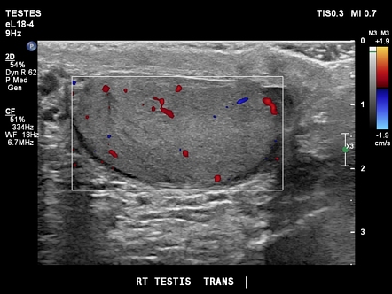 Epididymitis | Radiology Reference Article | Radiopaedia.org