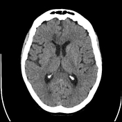 Egg and banana sign (pulmonary hypertension)