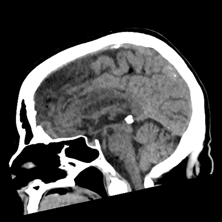 Pericallosal ACA infarction | Image | Radiopaedia.org