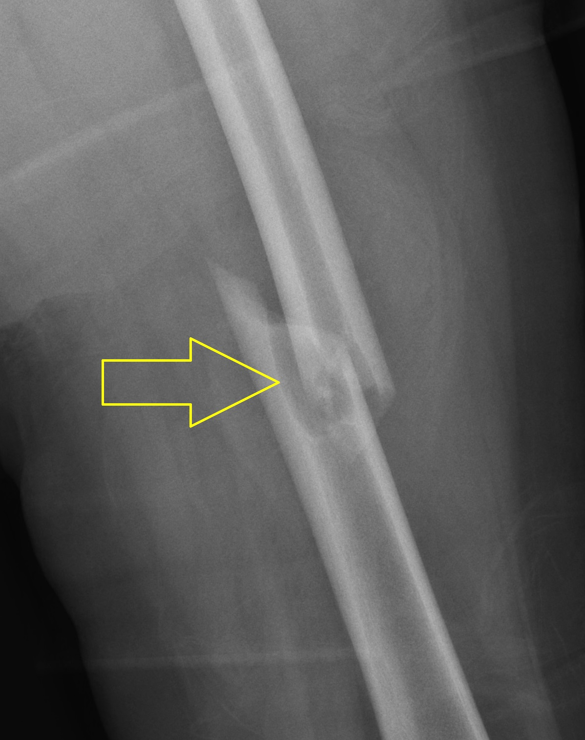 Unicameral Bone Cyst With Fracture Femur Image