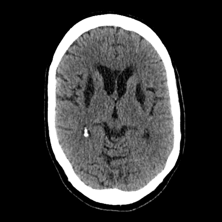 Previous methanol poisoning | Radiology Case | Radiopaedia.org