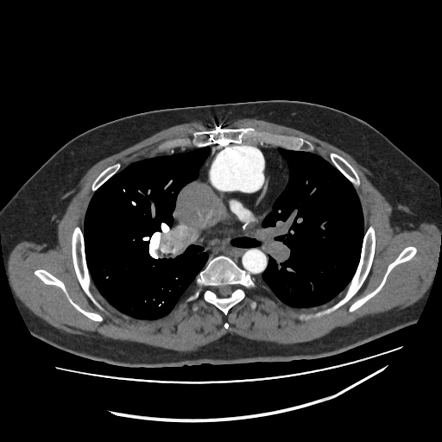 Fontan circulation | Radiology Case | Radiopaedia.org