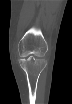 Tibial plateau fracture | Radiology Case | Radiopaedia.org