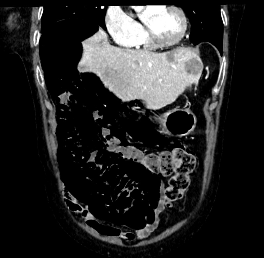 Chemotherapy-induced cystic pneumatosis intestinalis | Image ...