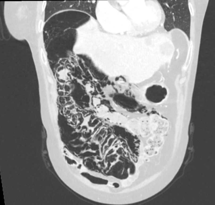 Chemotherapy-induced cystic pneumatosis intestinalis | Image ...