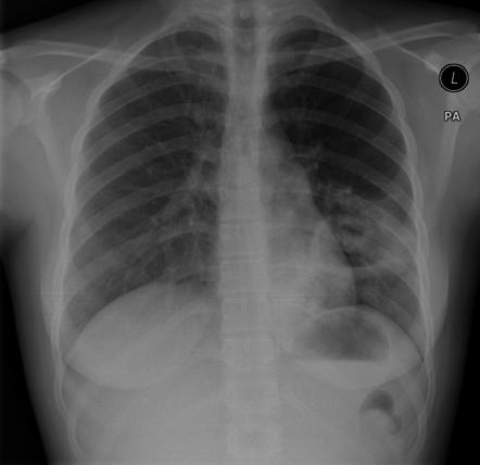 Pulmonary tuberculosis | Radiology Case | Radiopaedia.org