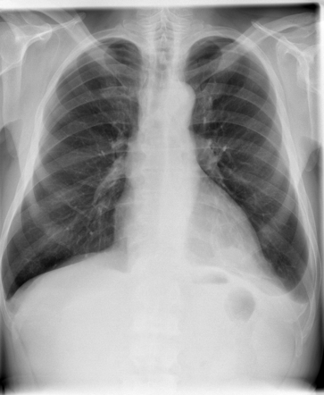 Round atelectasis | Image | Radiopaedia.org