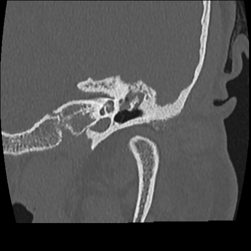 Congenital Cholesteatoma Recurrent Image