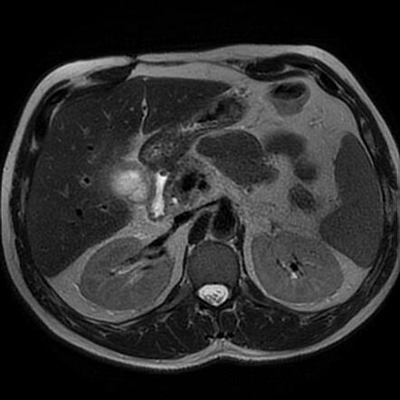 Gallbladder remnant cholecystitis | Radiology Case | Radiopaedia.org