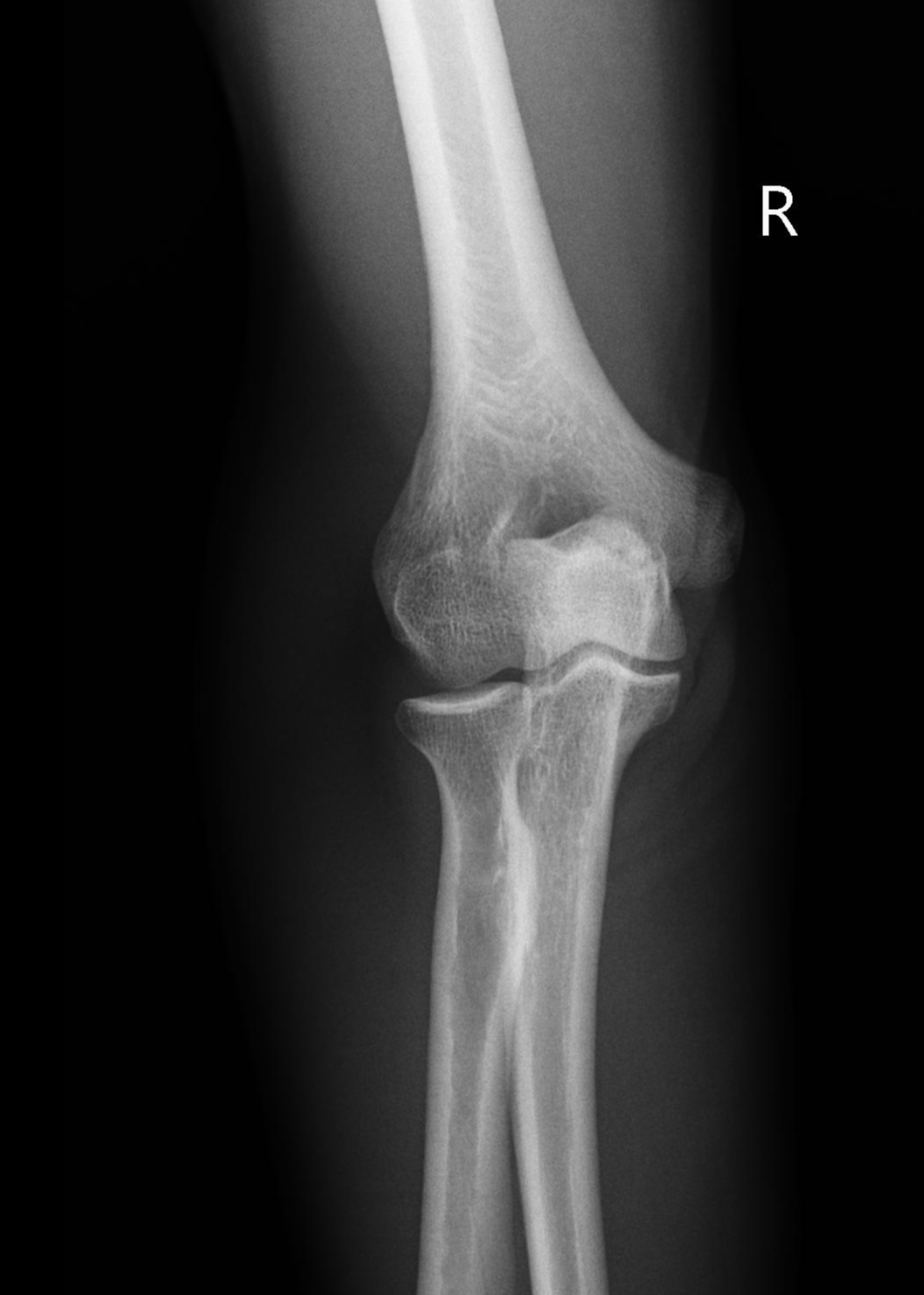 Triceps tendon enthesopathy | Image | Radiopaedia.org