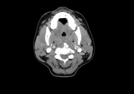 Calcific Tendinitis Of The Longus Colli Muscle | Image | Radiopaedia.org