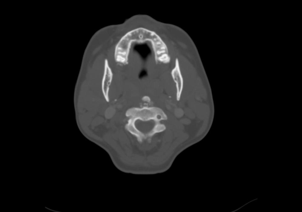 Calcific Tendinitis Of The Longus Colli Muscle | Image | Radiopaedia.org