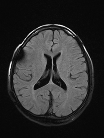 Blake pouch cyst | Image | Radiopaedia.org