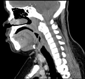 Calcific Tendinitis Of The Longus Colli Muscle | Radiology Reference ...