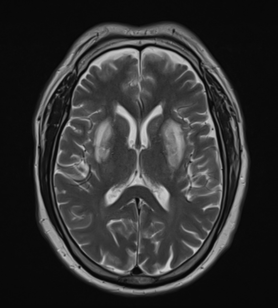 Methanol poisoning | Image | Radiopaedia.org