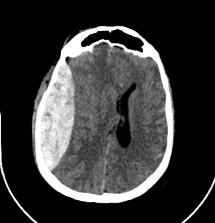 Extradural hemorrhage | Radiology Reference Article | Radiopaedia.org