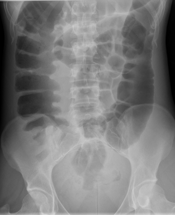 Sigmoid intussusception due to adenocarcinoma | Radiology Case ...