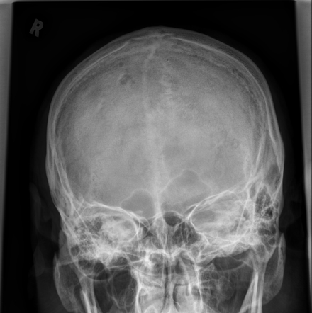 Skull (AP view) | Radiology Reference Article | Radiopaedia.org