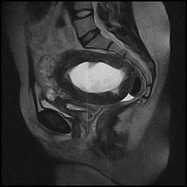 Cystic degeneration of a leiomyoma | Radiology Reference Article ...