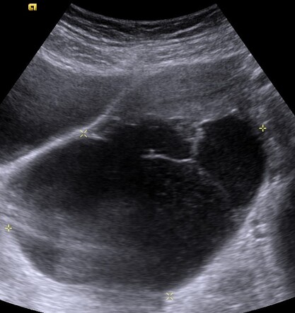 Cystic struma ovarii tumor | Image | Radiopaedia.org