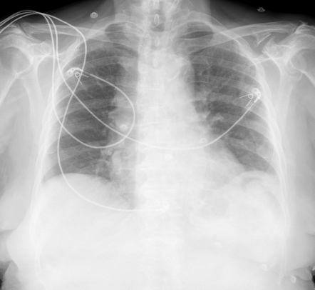 Coracoclavicular joint osteoarthritis | Radiology Case | Radiopaedia.org