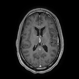 Progressive Multifocal Leukoencephalopathy (PML) | Image | Radiopaedia.org