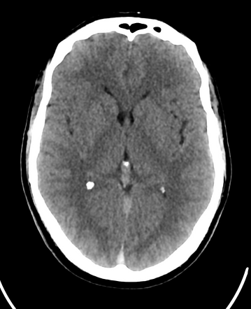 Dural Venous Sinus Thrombosis 