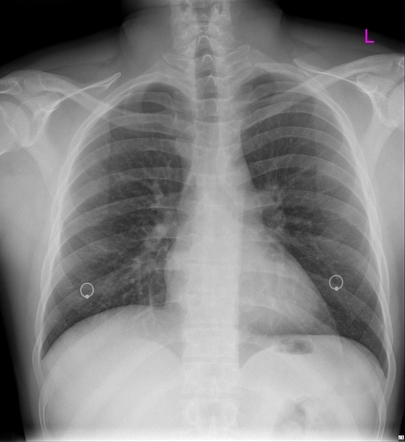 Nipple rings | Radiology Case | Radiopaedia.org