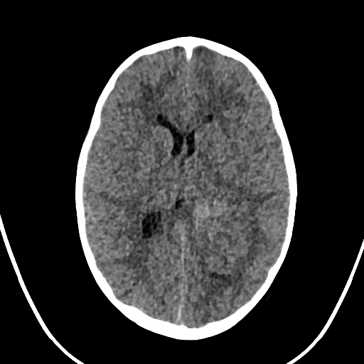 Atypical Choroid Plexus Papilloma Image 0727