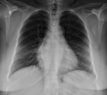 Double right heart border sign | Radiology Case | Radiopaedia.org