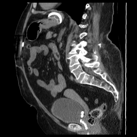 Bladder and urethral calculi | Radiology Case | Radiopaedia.org