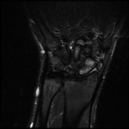 Scaphoid nonunion with humpback and DISI deformities | Image ...