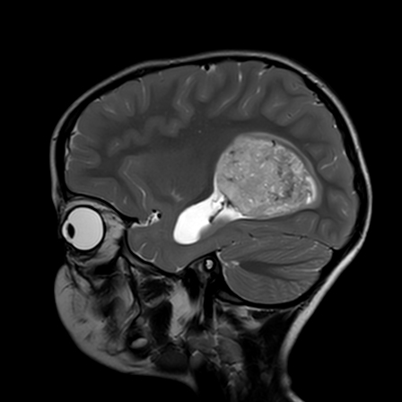 Atypical choroid plexus papilloma | Image | Radiopaedia.org