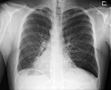 Kartagener syndrome | Radiology Case | Radiopaedia.org