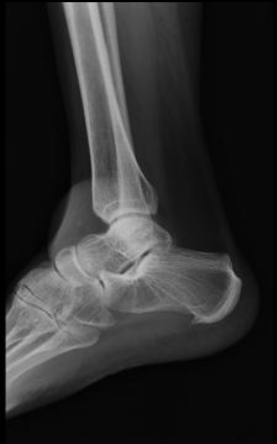 Ankle bursitis | Image | Radiopaedia.org