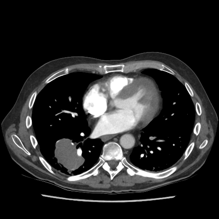 Pulmonary Emboli And Pneumonia With Metastatic Cancer 