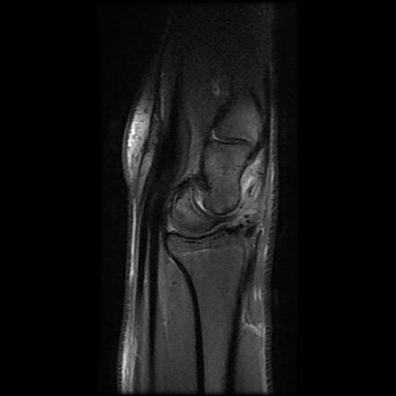 Dorsal intercalated segment instability | Radiology Reference Article ...