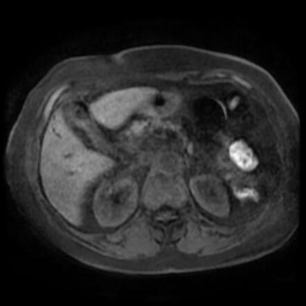 Cystic duct stump stone | Image | Radiopaedia.org