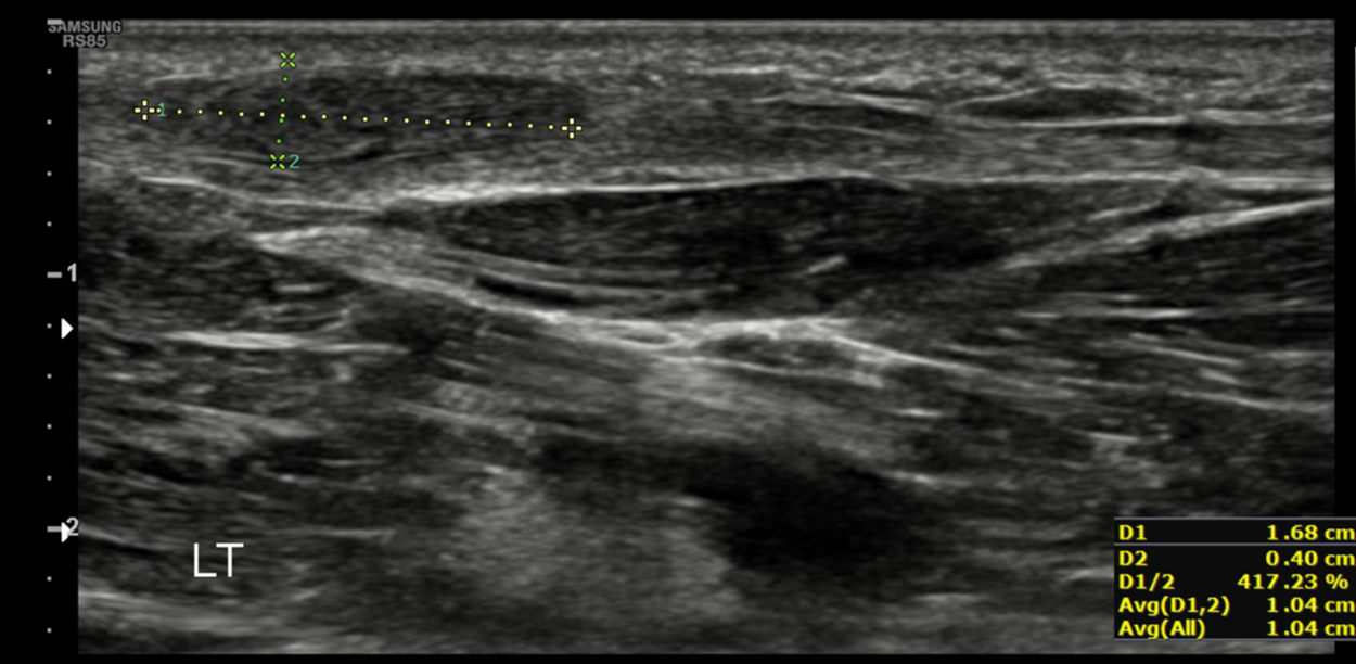 Plantar fibromatosis | Image | Radiopaedia.org