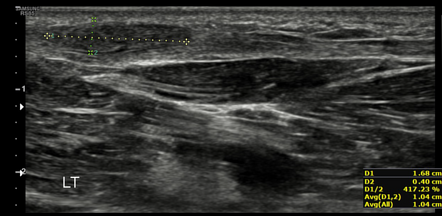 Plantar Fibromatosis 