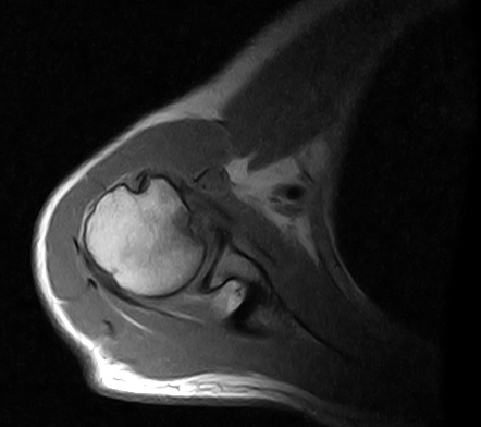 Posterior shoulder dislocation with reverse Hill Sachs defect and ...