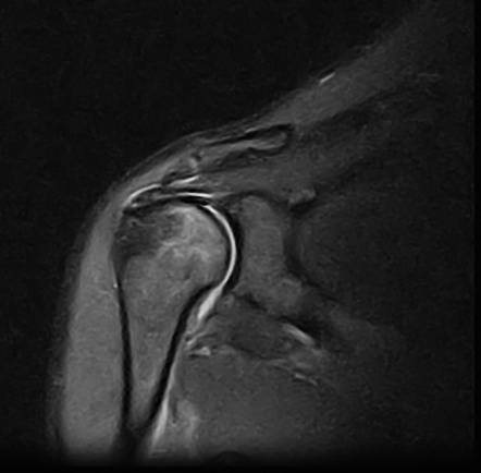 Posterior shoulder dislocation with reverse Hill Sachs defect and ...