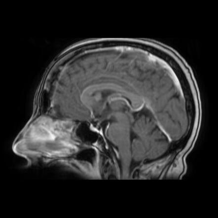 Brain Metastases From Breast Carcinoma | Image | Radiopaedia.org