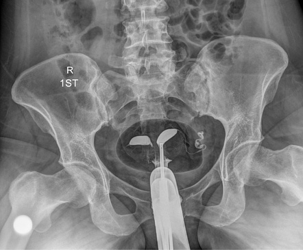 Uterus Didelphys | Radiology Case | Radiopaedia.org