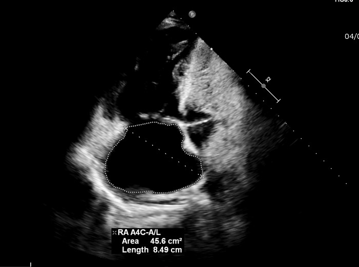 Cor pulmonale | Image | Radiopaedia.org