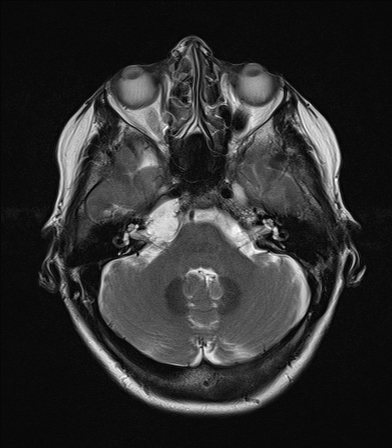 Base of skull chondrosarcoma | Image | Radiopaedia.org