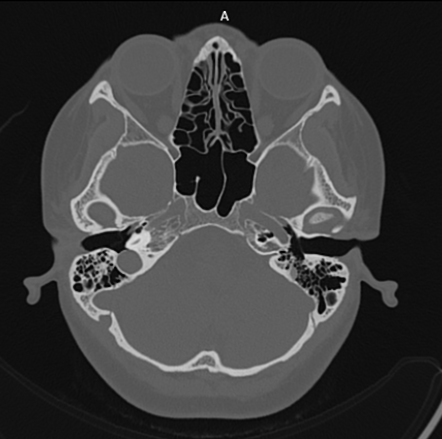 Bilateral Fenestral Otosclerosis 