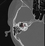 Otosclerosis | Radiology Reference Article | Radiopaedia.org