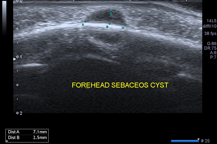 Forehead epidermal inclusion cyst - sebaceous cyst | Radiology Case ...