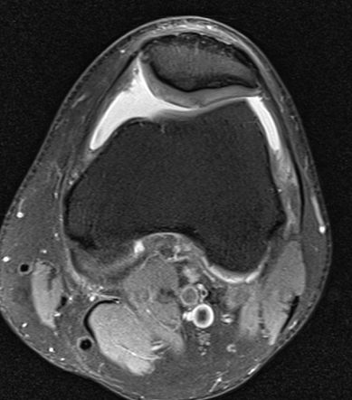 acute traumatic bucket handle tear of right medial meniscus icd 10